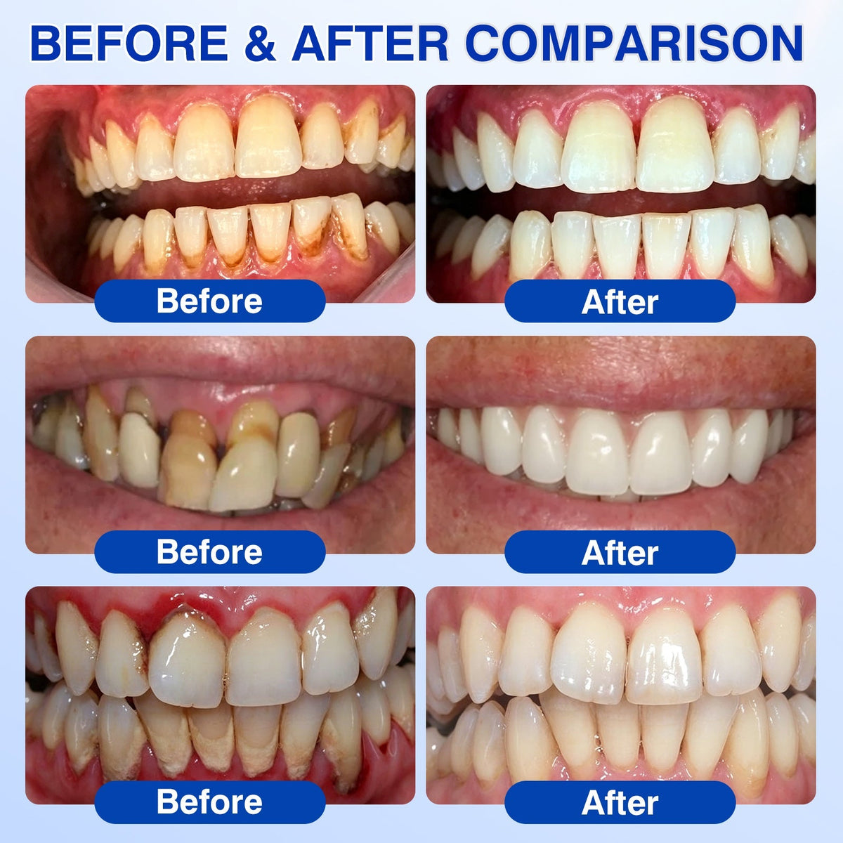 🔥Last Day 49% OFF 🔥Purelora® GumRevive Periodontal Repair Gel