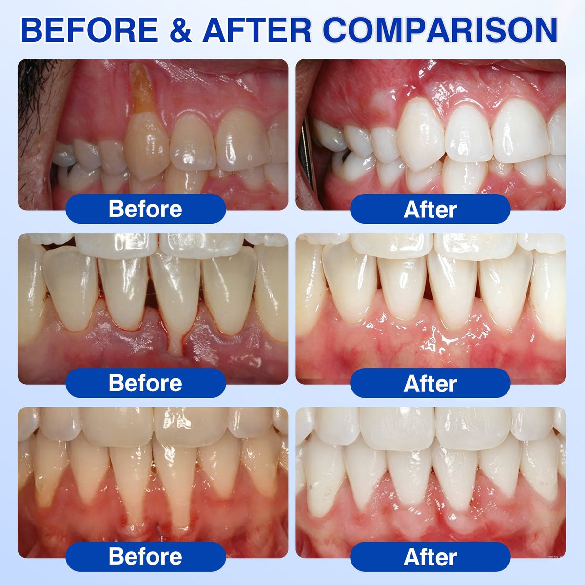 🔥Last Day 49% OFF 🔥Purelora® GumRevive Periodontal Repair Gel