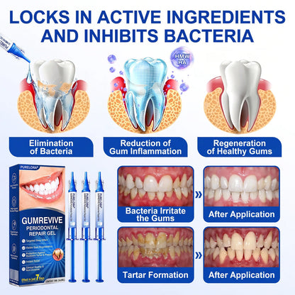 🔥Last Day 49% OFF 🔥Purelora® GumRevive Periodontal Repair Gel